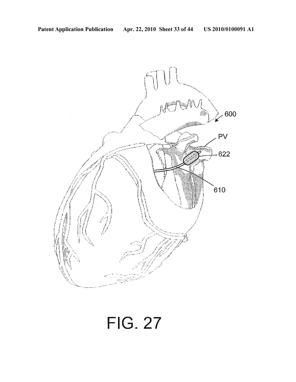 TISSUE ABLATION SYSTEMS - diagram, schematic, and image 34