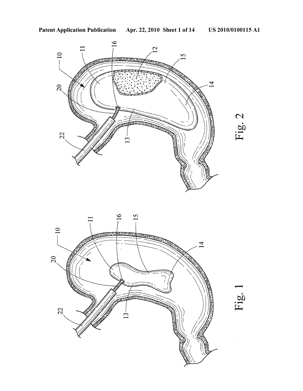 FOAM FILLED INTRAGASTRIC BALLOON FOR TREATING OBESITY - diagram, schematic, and image 02