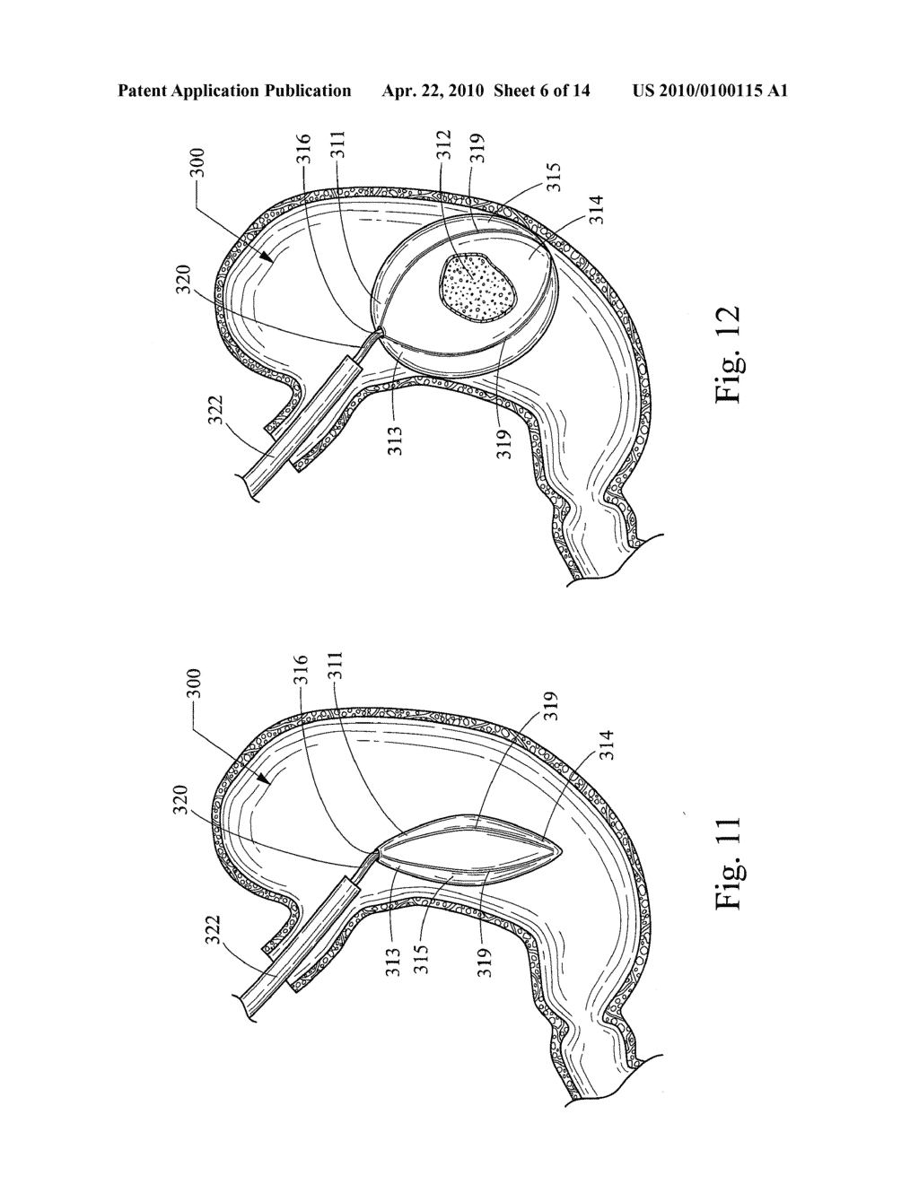 FOAM FILLED INTRAGASTRIC BALLOON FOR TREATING OBESITY - diagram, schematic, and image 07