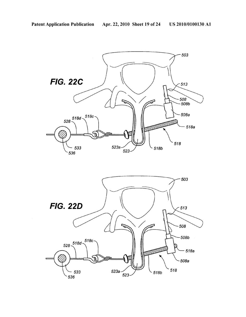 DEVICE AND METHOD FOR CORRECTING A SPINAL DEFORMITY - diagram, schematic, and image 20