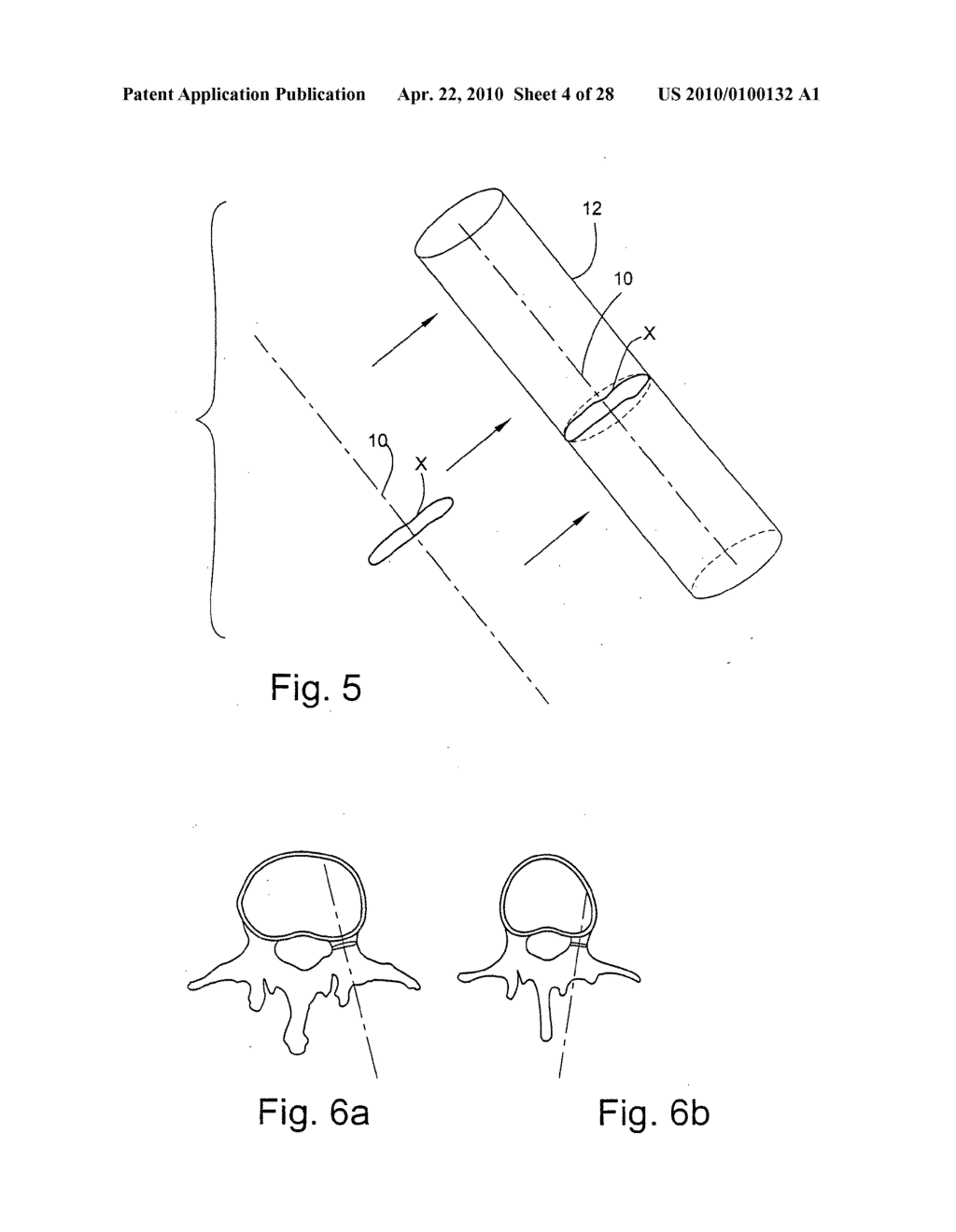 System and methods for improved access to vertebral bodies for kyphoplasty, vertebroplsaty, vertebral body biopsy or screw placement - diagram, schematic, and image 05