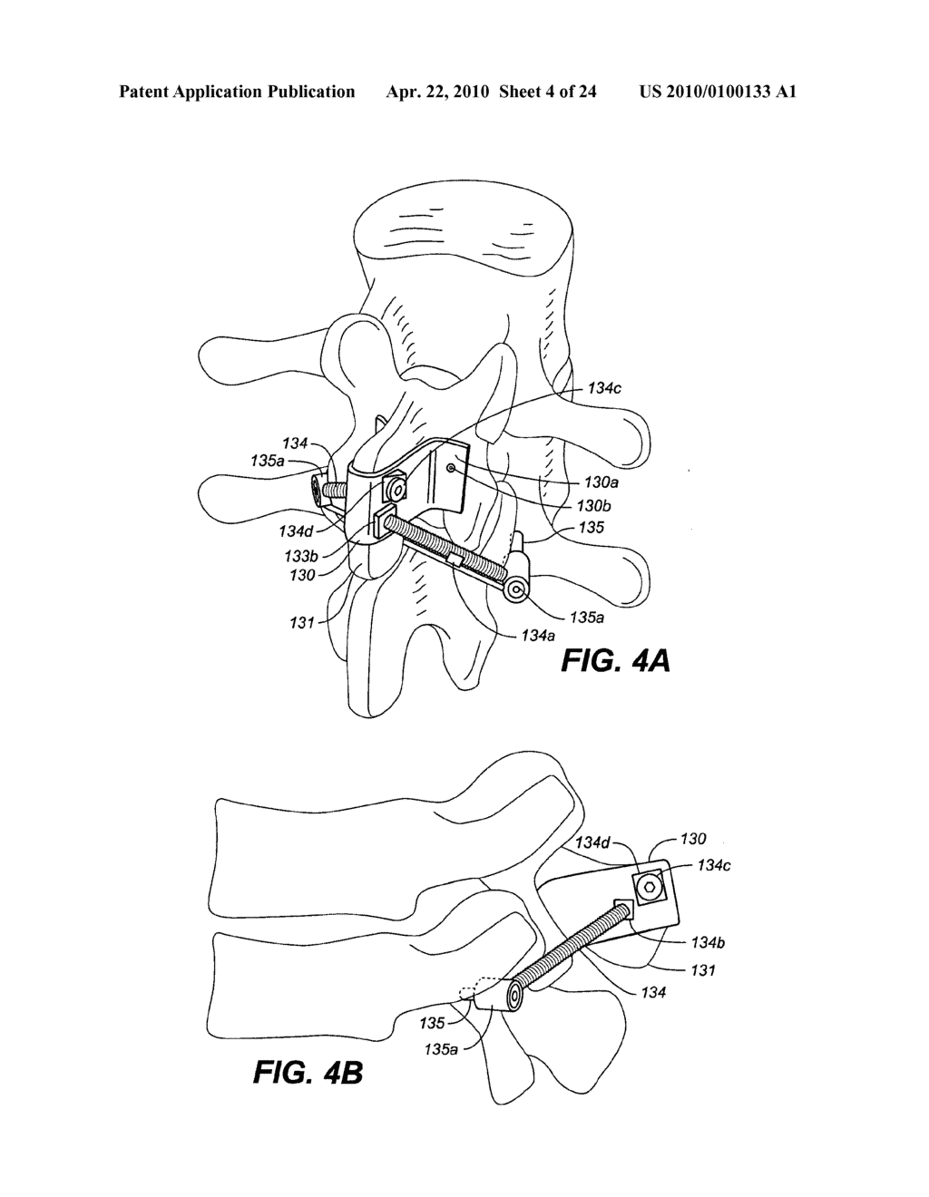 DEVICE AND METHOD FOR CORRECTING A SPINAL DEFORMITY - diagram, schematic, and image 05