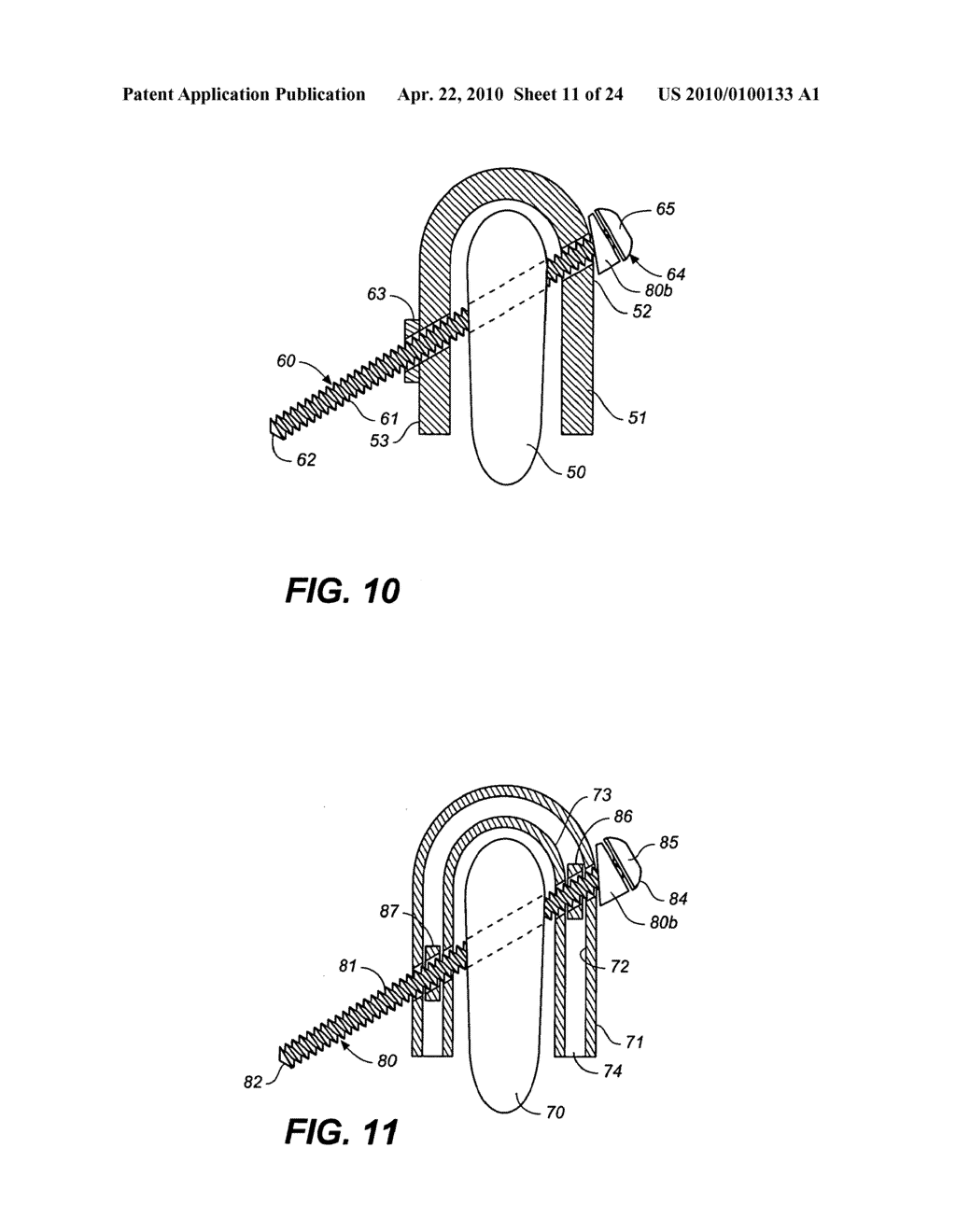 DEVICE AND METHOD FOR CORRECTING A SPINAL DEFORMITY - diagram, schematic, and image 12