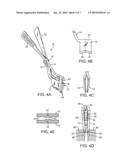 Methods and Apparatus For Intervertebral Disc Prosthesis Insertion diagram and image