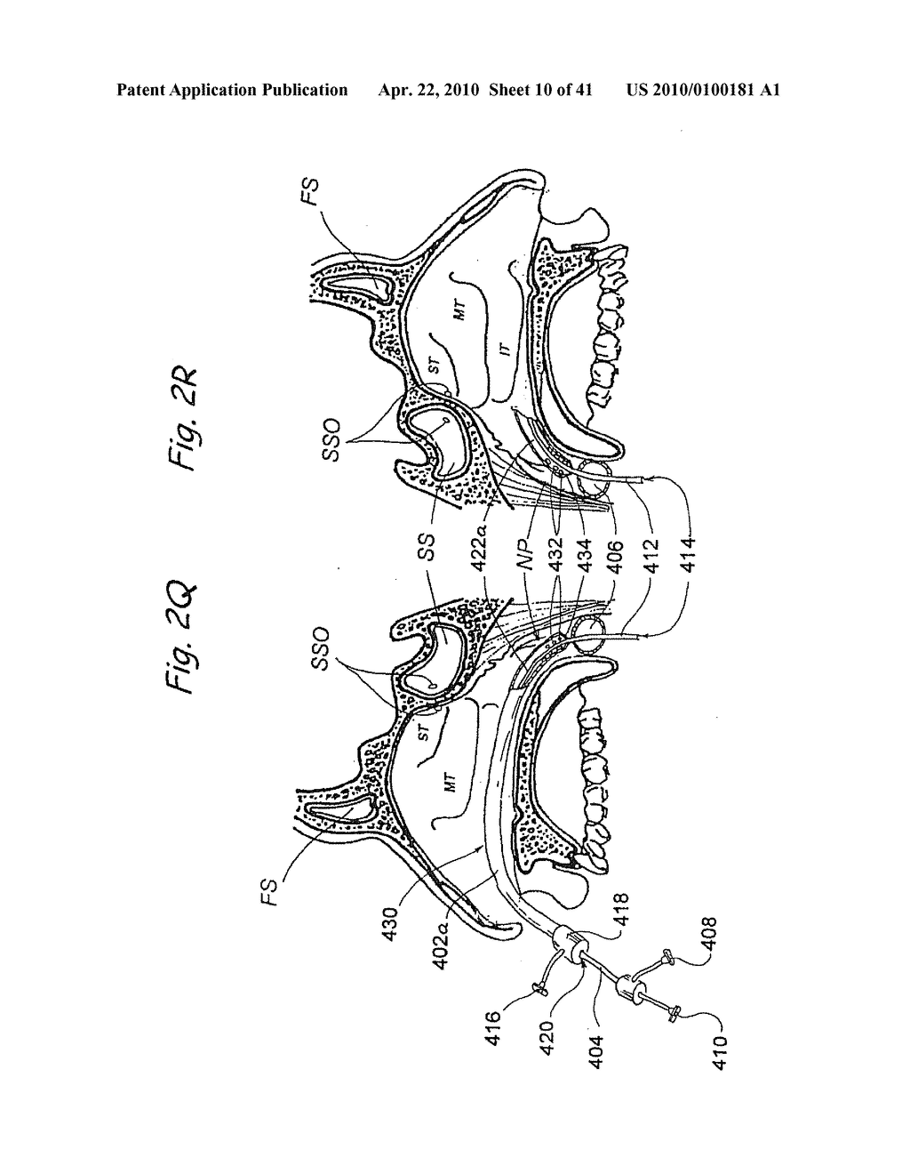 DEVICES, SYSTEMS AND METHODS FOR DIAGNOSING AND TREATING SINUSITUS ANDOTHER DISORDERS OF THE EARS, NOSE AND/OR THROAT - diagram, schematic, and image 11