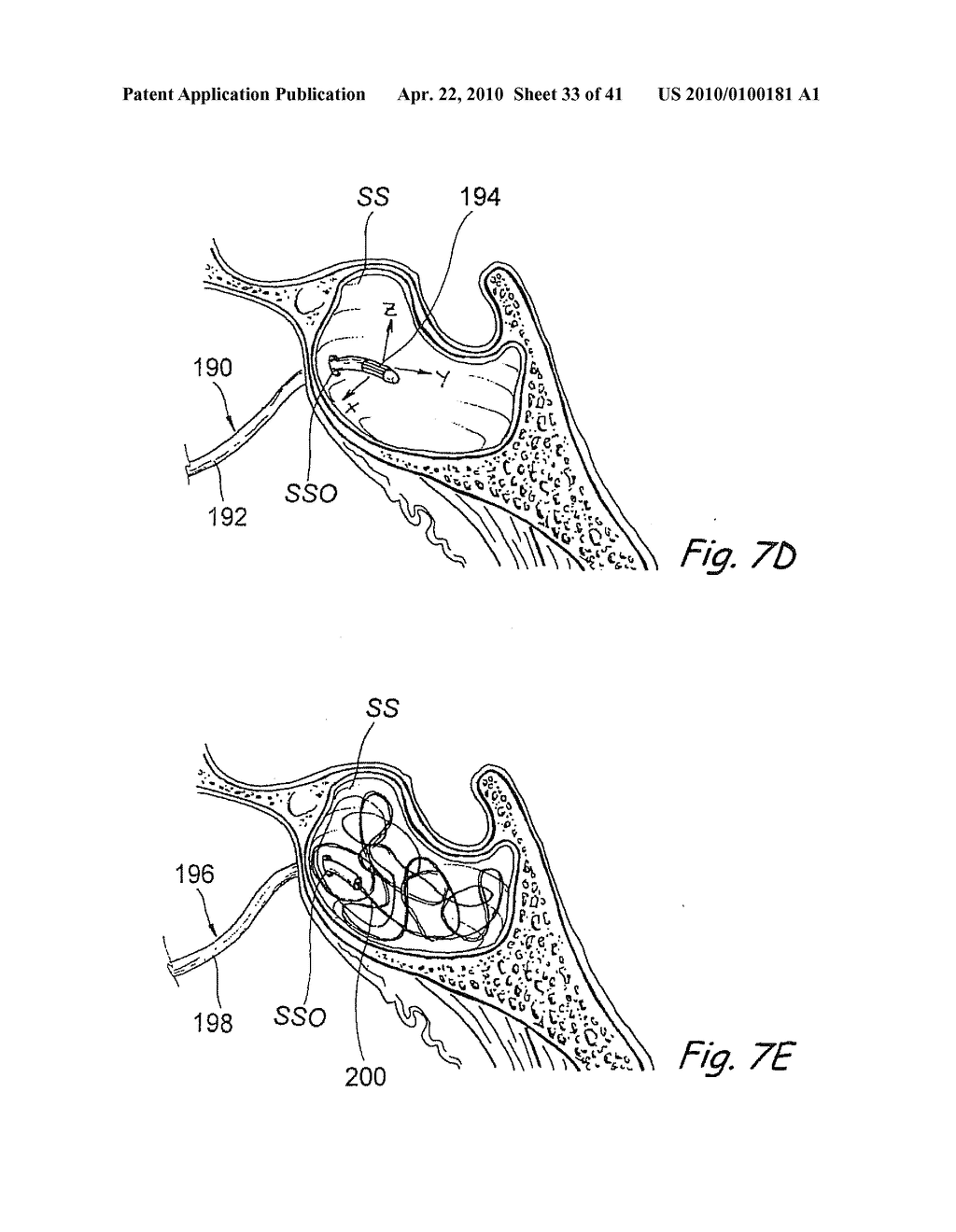 DEVICES, SYSTEMS AND METHODS FOR DIAGNOSING AND TREATING SINUSITUS ANDOTHER DISORDERS OF THE EARS, NOSE AND/OR THROAT - diagram, schematic, and image 34