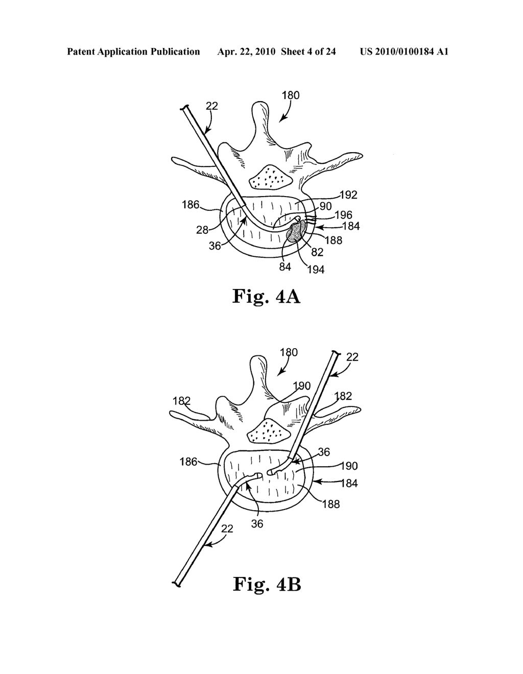 METHOD AND STRUCTURE FOR STABILIZING A VERTEBRAL BODY - diagram, schematic, and image 05