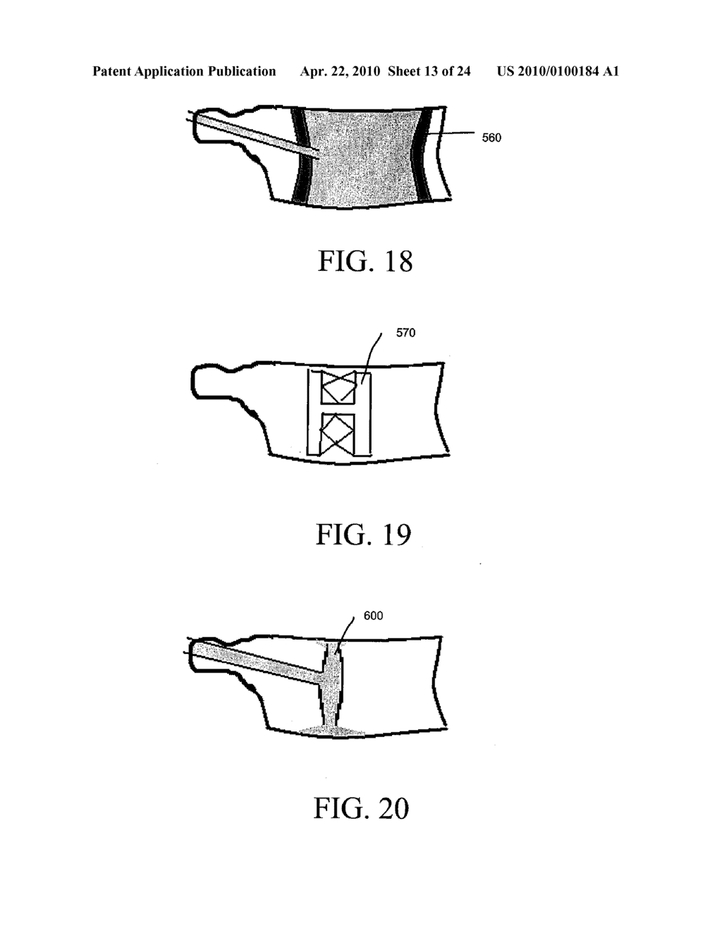 METHOD AND STRUCTURE FOR STABILIZING A VERTEBRAL BODY - diagram, schematic, and image 14