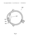 Apparatus and Method For The Treatment of Cataract diagram and image