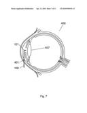 Apparatus and Method For The Treatment of Cataract diagram and image