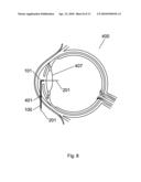 Apparatus and Method For The Treatment of Cataract diagram and image