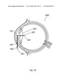 Apparatus and Method For The Treatment of Cataract diagram and image