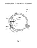 Apparatus and Method For The Treatment of Cataract diagram and image