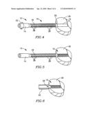 Implant and delivery tool therefor diagram and image