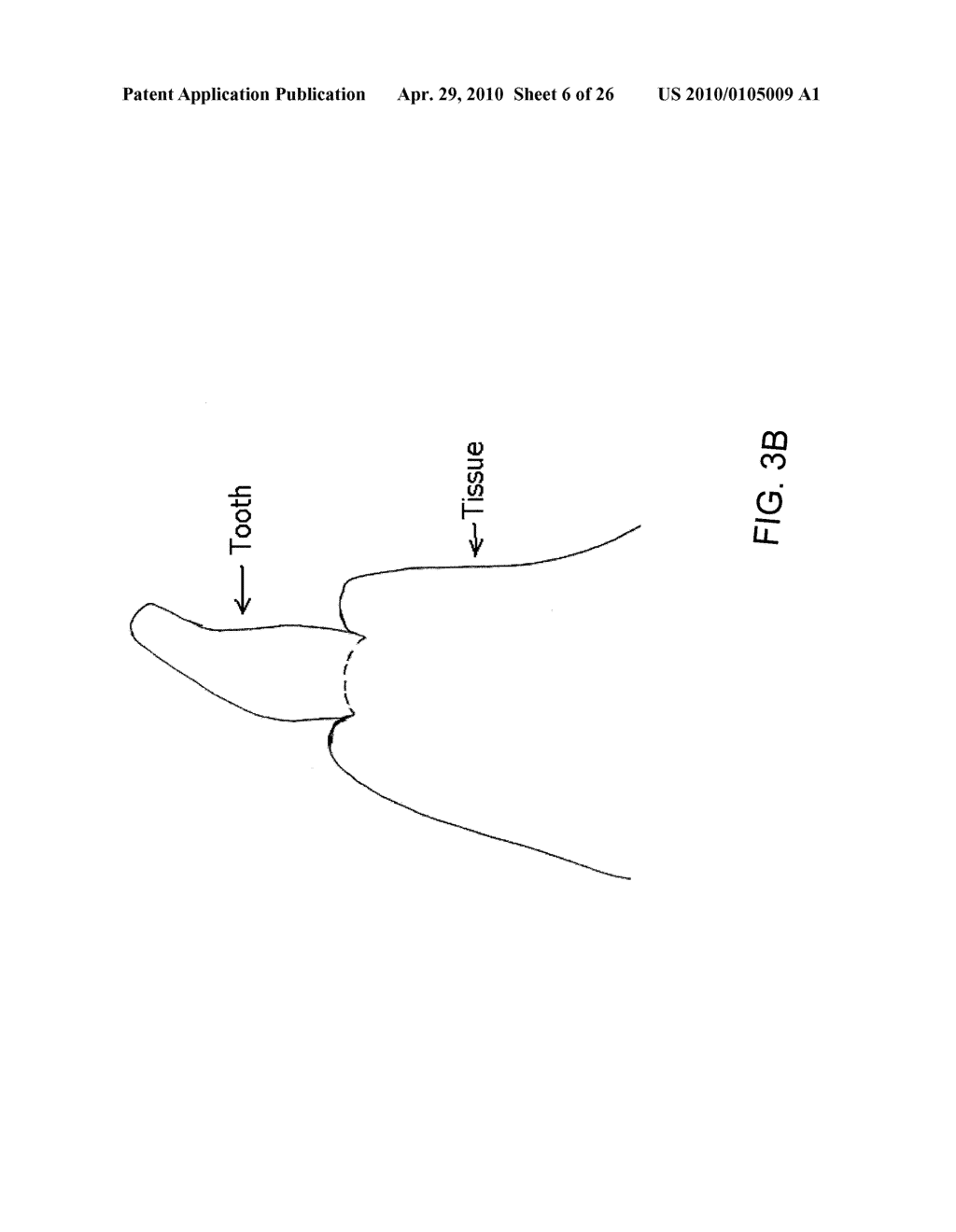 System, Method And Apparatus For Tooth Implants - diagram, schematic, and image 07