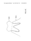 System, Method And Apparatus For Tooth Implants diagram and image