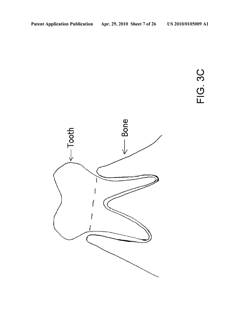 System, Method And Apparatus For Tooth Implants - diagram, schematic, and image 08