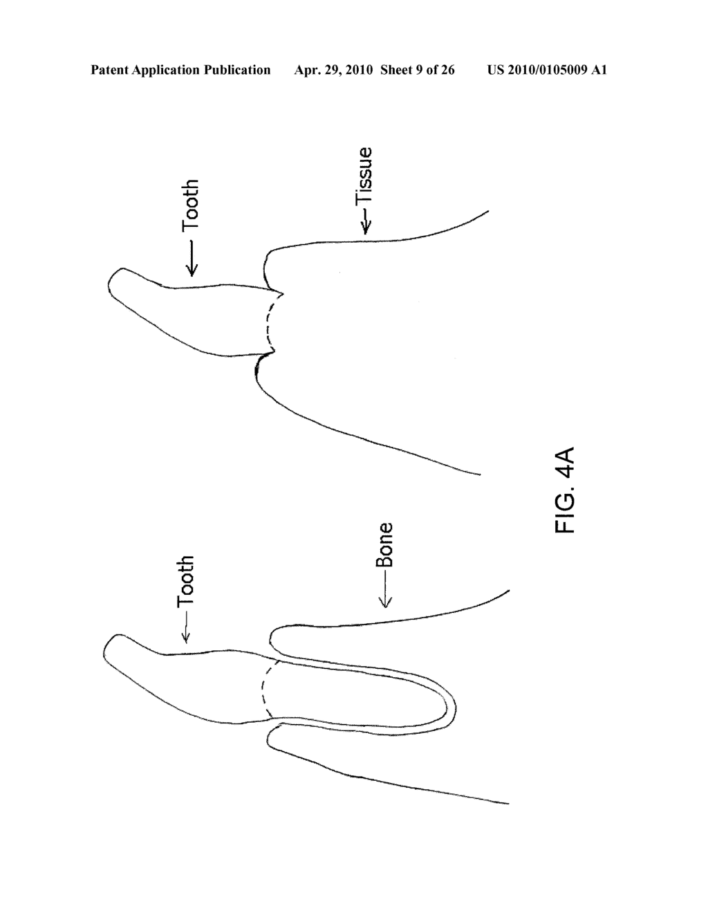 System, Method And Apparatus For Tooth Implants - diagram, schematic, and image 10