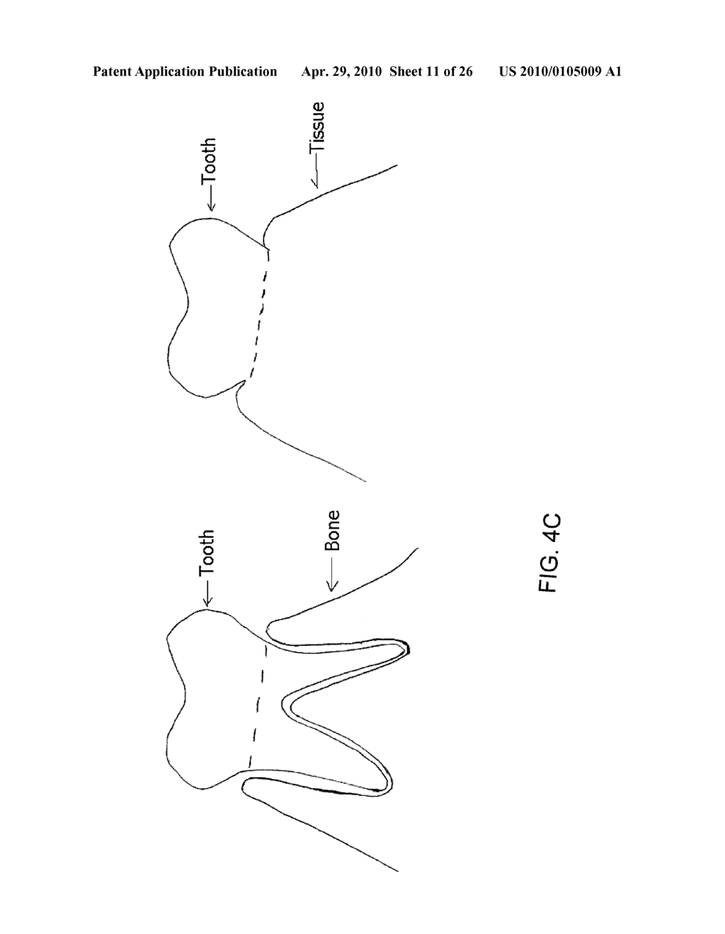 System, Method And Apparatus For Tooth Implants - diagram, schematic, and image 12