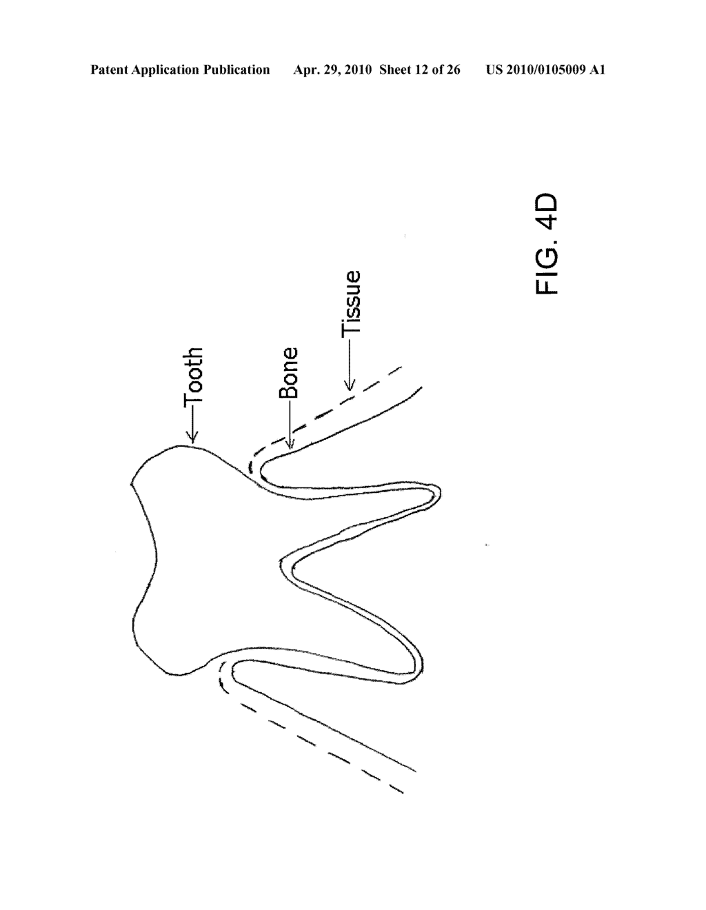 System, Method And Apparatus For Tooth Implants - diagram, schematic, and image 13