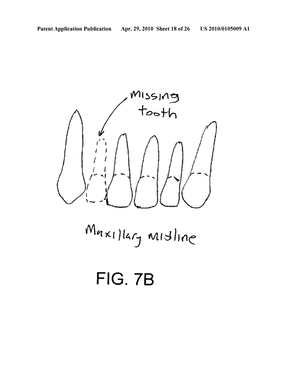 System, Method And Apparatus For Tooth Implants - diagram, schematic, and image 19