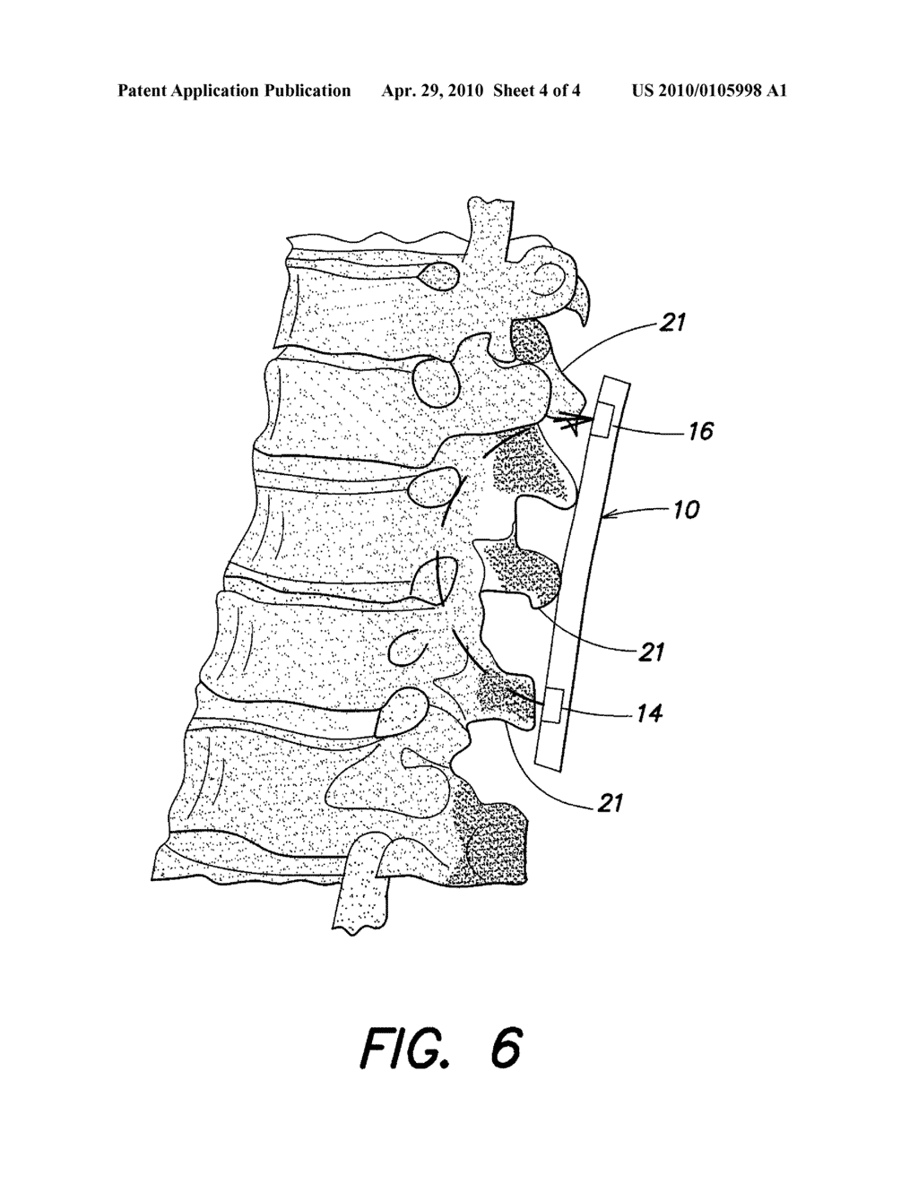 METHOD AND APPARATUS FOR SPECTROPHOTOMETRIC BASED OXIMETRY OF SPINAL TISSUE - diagram, schematic, and image 05