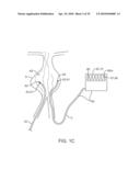 SYSTEM AND METHODS FOR ENDOVASCULAR ANEURYSM TREATMENT diagram and image