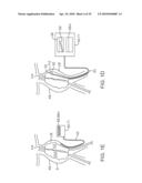 SYSTEM AND METHODS FOR ENDOVASCULAR ANEURYSM TREATMENT diagram and image