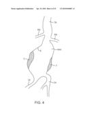 SYSTEM AND METHODS FOR ENDOVASCULAR ANEURYSM TREATMENT diagram and image