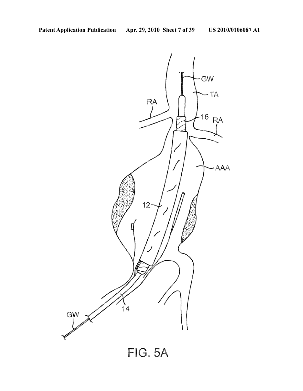 SYSTEM AND METHODS FOR ENDOVASCULAR ANEURYSM TREATMENT - diagram, schematic, and image 08