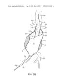 SYSTEM AND METHODS FOR ENDOVASCULAR ANEURYSM TREATMENT diagram and image