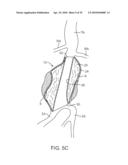 SYSTEM AND METHODS FOR ENDOVASCULAR ANEURYSM TREATMENT diagram and image