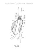 SYSTEM AND METHODS FOR ENDOVASCULAR ANEURYSM TREATMENT diagram and image