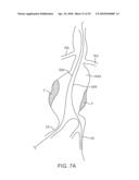 SYSTEM AND METHODS FOR ENDOVASCULAR ANEURYSM TREATMENT diagram and image