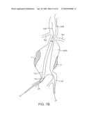 SYSTEM AND METHODS FOR ENDOVASCULAR ANEURYSM TREATMENT diagram and image