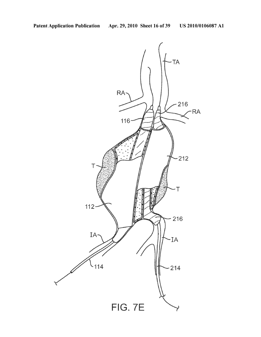 SYSTEM AND METHODS FOR ENDOVASCULAR ANEURYSM TREATMENT - diagram, schematic, and image 17