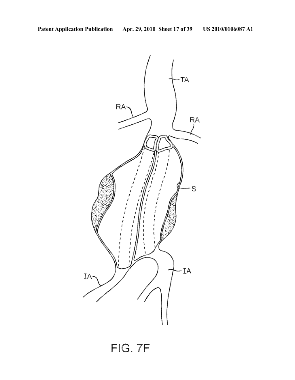 SYSTEM AND METHODS FOR ENDOVASCULAR ANEURYSM TREATMENT - diagram, schematic, and image 18