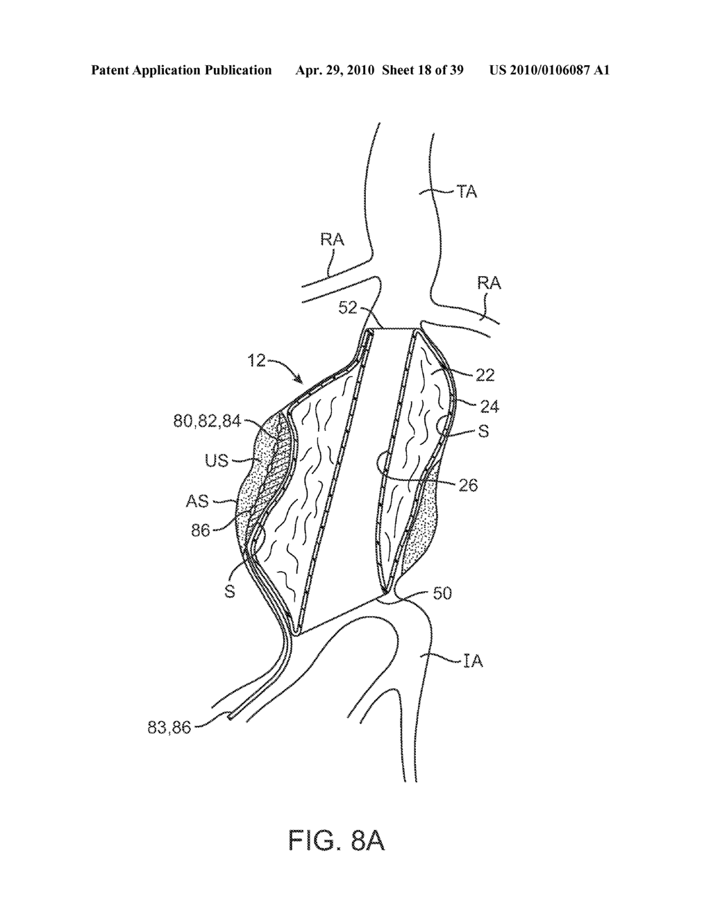 SYSTEM AND METHODS FOR ENDOVASCULAR ANEURYSM TREATMENT - diagram, schematic, and image 19