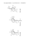 SYSTEM AND METHODS FOR ENDOVASCULAR ANEURYSM TREATMENT diagram and image