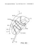 SYSTEM AND METHODS FOR ENDOVASCULAR ANEURYSM TREATMENT diagram and image