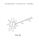 SYSTEM AND METHODS FOR ENDOVASCULAR ANEURYSM TREATMENT diagram and image