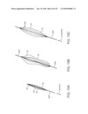 SYSTEM AND METHODS FOR ENDOVASCULAR ANEURYSM TREATMENT diagram and image