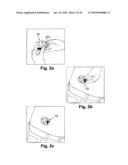 PORTABLE INFUSION PUMP WITH CANNULA INSERTER AND PAIN REDUCTION MECHANISM diagram and image