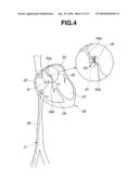 High-frequency surgical apparatus and high-frequency surgical method for closure of patent foramen ovale diagram and image