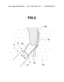 High-frequency surgical apparatus and high-frequency surgical method for closure of patent foramen ovale diagram and image