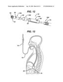 METHODS AND DEVICES FOR APPLYING MULITPLE SUTURE ANCHORS diagram and image