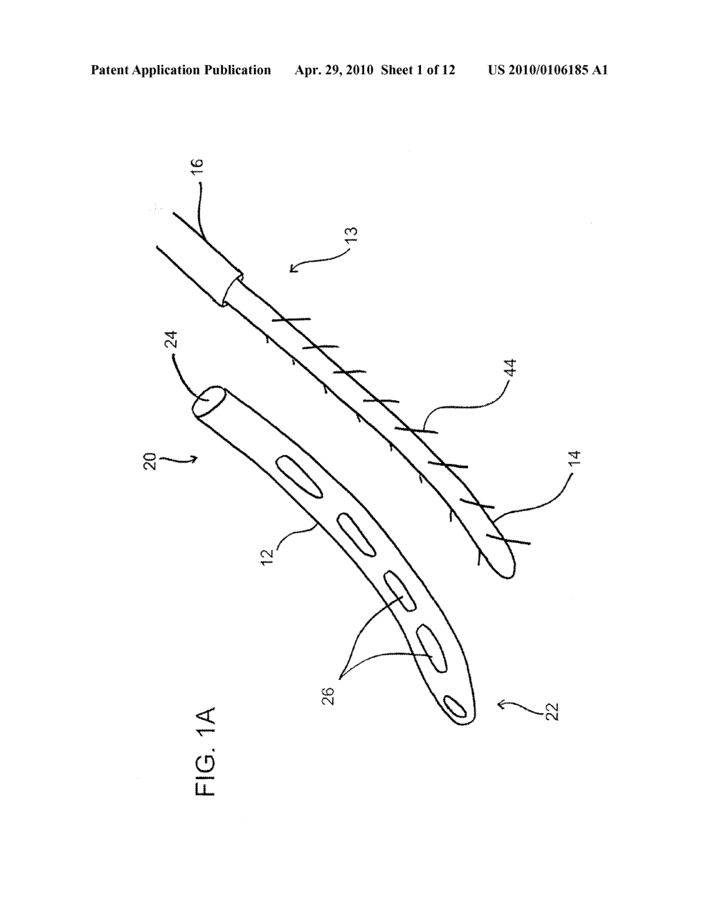 DEVICES, SYSTEMS, AND METHODS FOR ENDOSCOPIC GASTRIC MAGNETIC RESTRICTION - diagram, schematic, and image 02