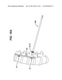 LOW PROFILE SPINAL TETHERING METHODS diagram and image