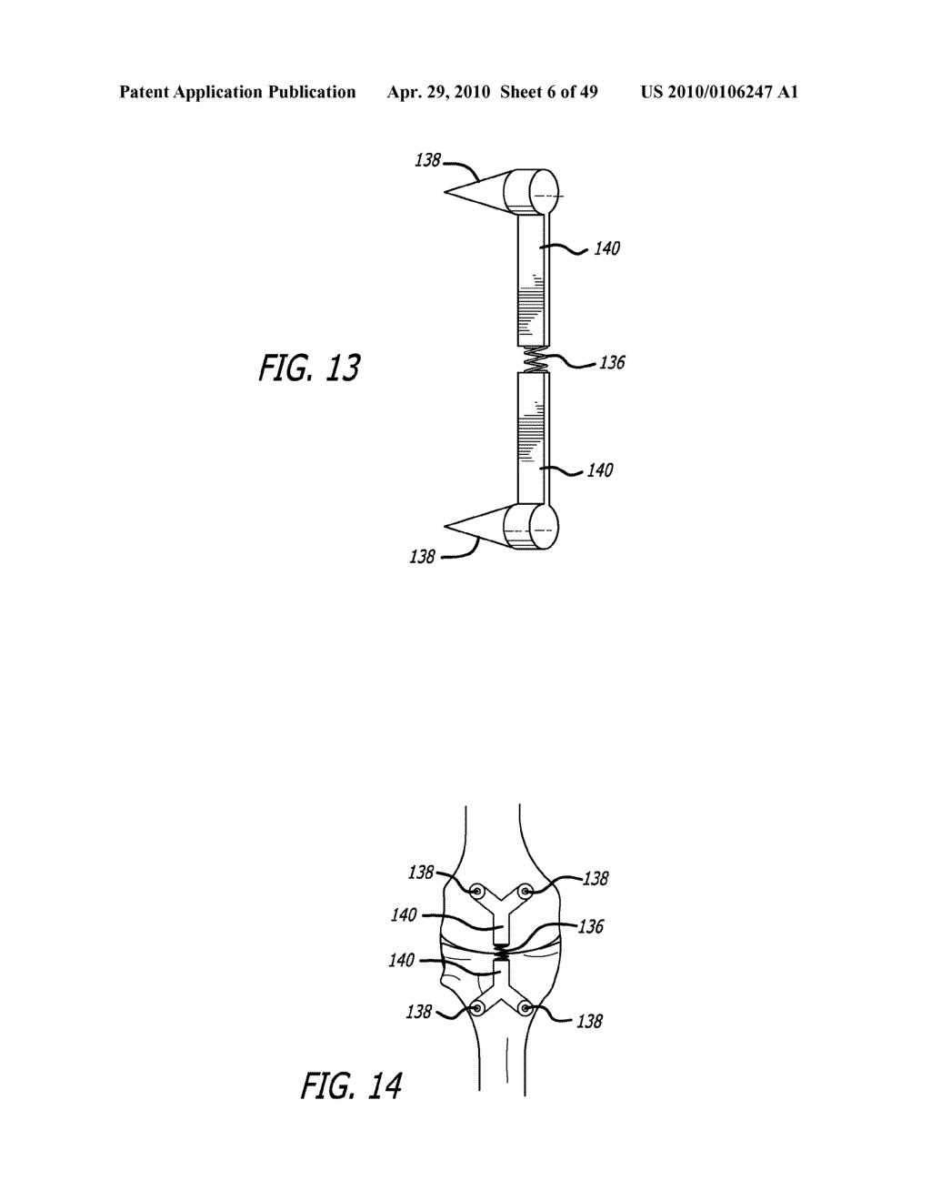 Extra-Articular Implantable Mechanical Energy Absorbing Systems - diagram, schematic, and image 07