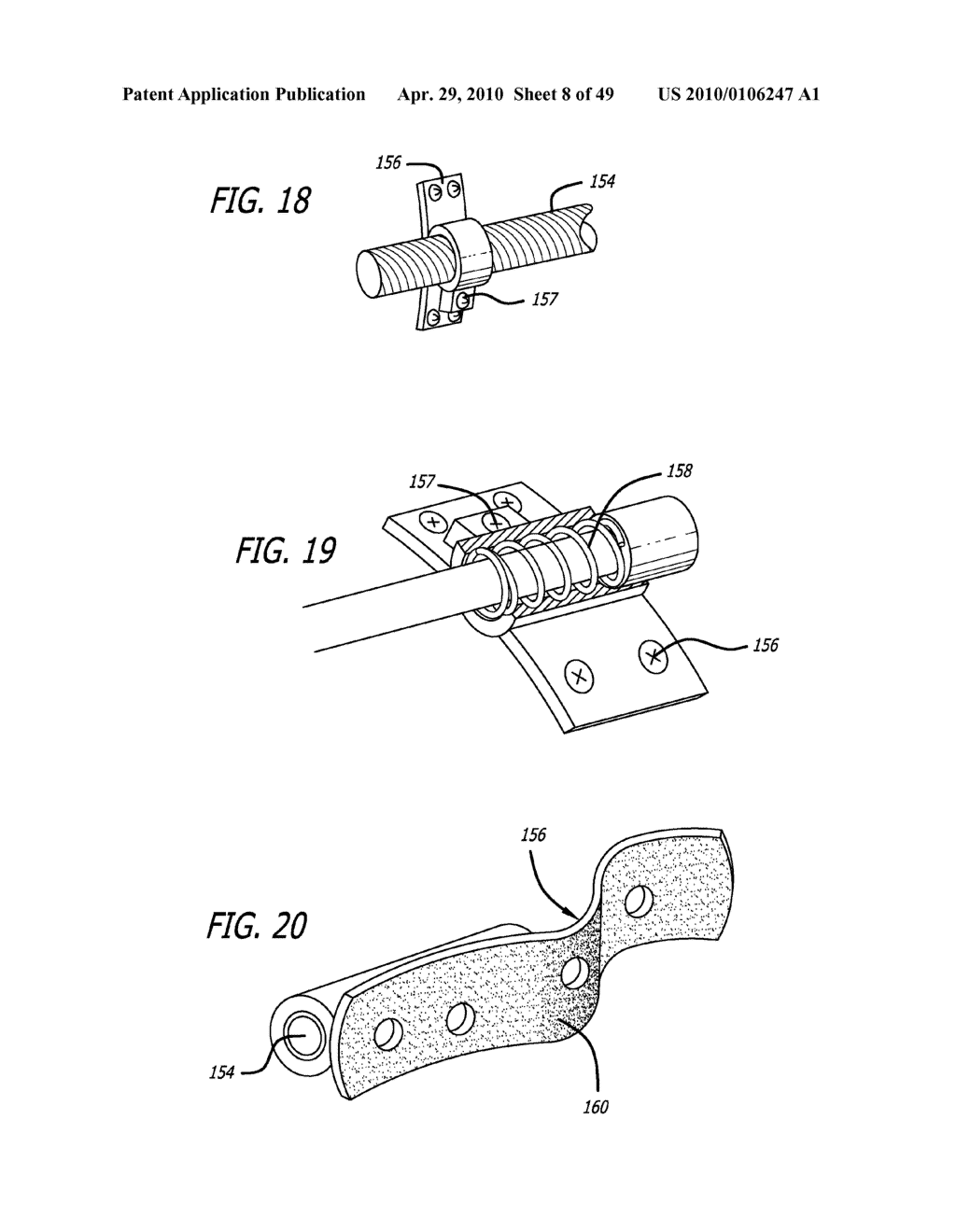 Extra-Articular Implantable Mechanical Energy Absorbing Systems - diagram, schematic, and image 09